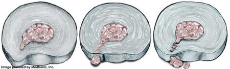 level-of-disc-heniation